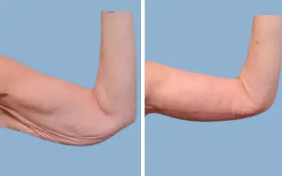 Before and After